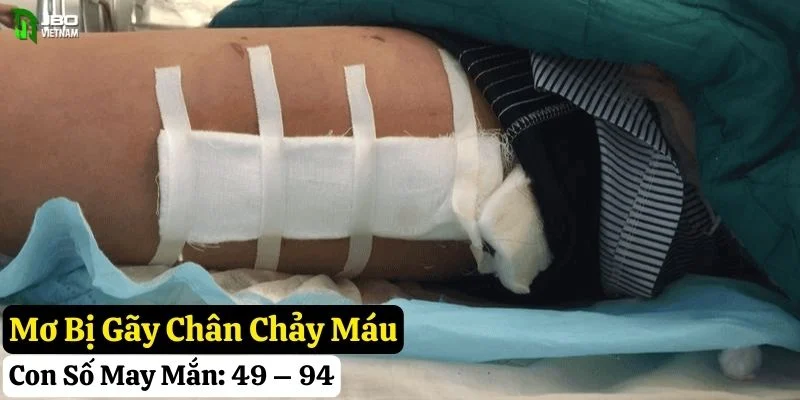 nằm mơ bị gãy chân